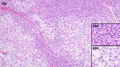 Ovarian steroid cell tumors: what do we know so far?